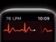 ECG de l'Apple Watch